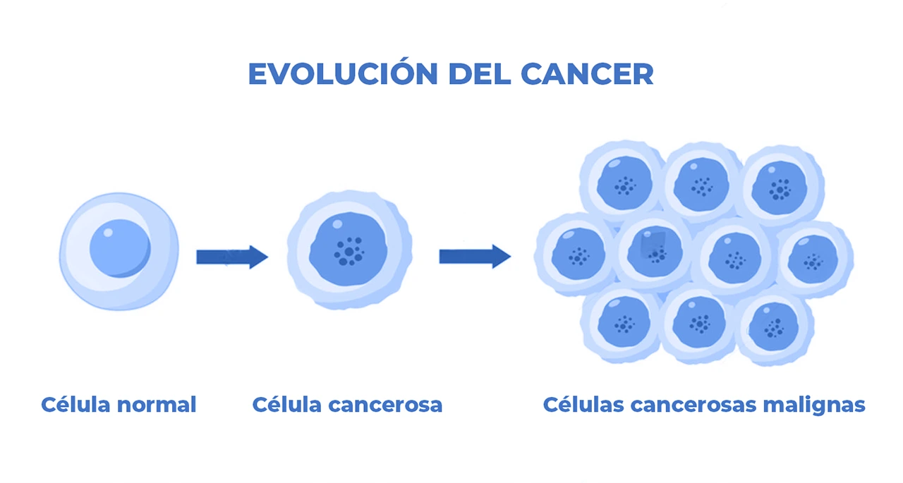 Ilustración que representa cómo evoluciona el cáncer, pasando de una célula normal, a una célula cancerosa y posteriormente a células malignas. Ilustración que representa cómo evoluciona el cáncer, pasando de una célula normal, a una célula cancerosa y posteriormente a células malignas.