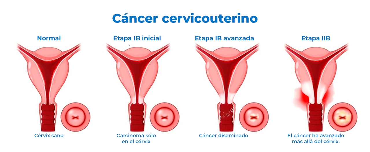 Ilustración de las diferentes tapadas de la estadificación del cáncer cervicouterino desde un estado normal hasta la esparción. Ilustración de las diferentes tapadas de la estadificación del cáncer cervicouterino desde un estado normal hasta la esparción.