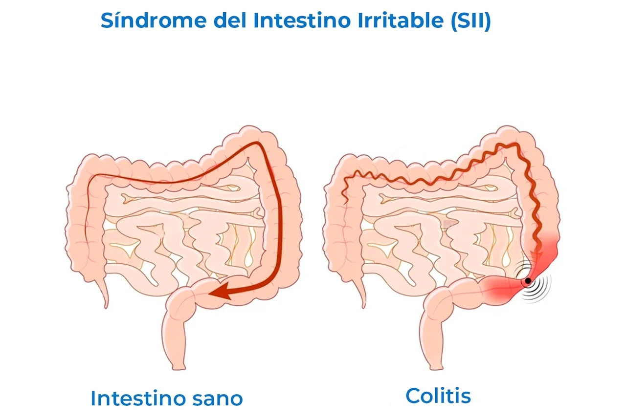 Dibujos que comparan un colon sano de uno con colitis nerviosa en el Síndrome del Intestino Irritable.