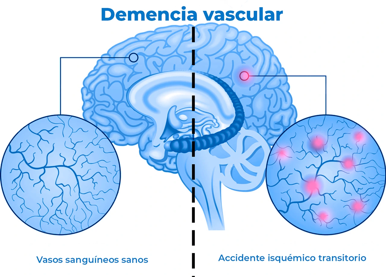 Demencia vascular: comparación entre vasos sanguíneos sanos y vasos afectados por un accidente isquémico transitorio. Dibujo comparativo en donde se visualizan vasos sanguíneos sanos del cerebro y otros afectados por ataques isquémicos transitorios.