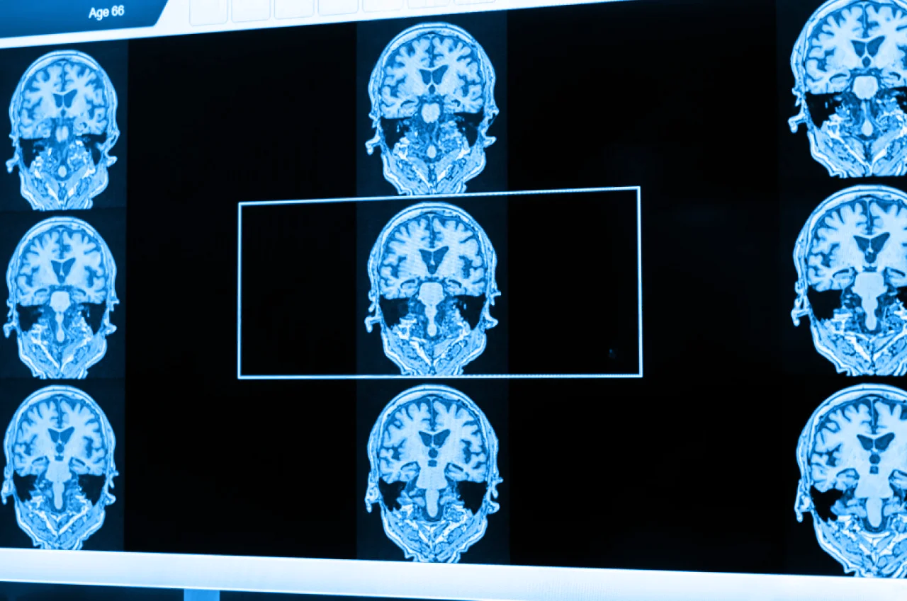 Resonancia magnética realizada en el diagnóstico de la demencia vascular para identificar el padecimiento de un paciente. Resonancia magnética realizada en el diagnóstico de la demencia vascular para identificar el padecimiento de un paciente.