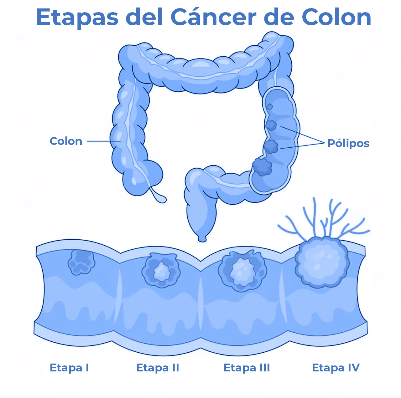 Ilustración que representa las etapas del cáncer de colon Ilustración que representa las etapas del cáncer de colon, indicando cómo se visualiza desde la etapa 1 hasta la etapa 4.