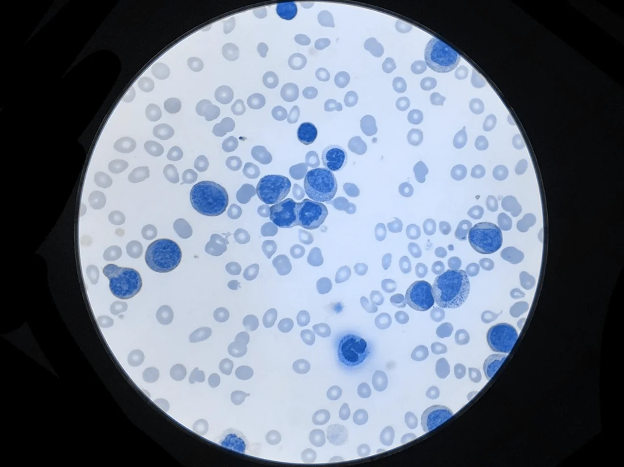 Célula de linfoma ampliada bajo un microscopio, como parte del estadio patológico para determinar las etapas del cáncer. Célula de linfoma ampliada bajo un microscopio, como parte del estadio patológico para determinar las etapas del cáncer.