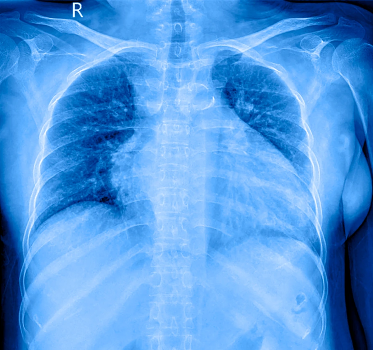 Radiografía del tórax como parte de los métodos diagnóstico para la detección de insuficiencia cardíaca. Radiografía del tórax como parte de los métodos diagnóstico para la detección de insuficiencia cardíaca.