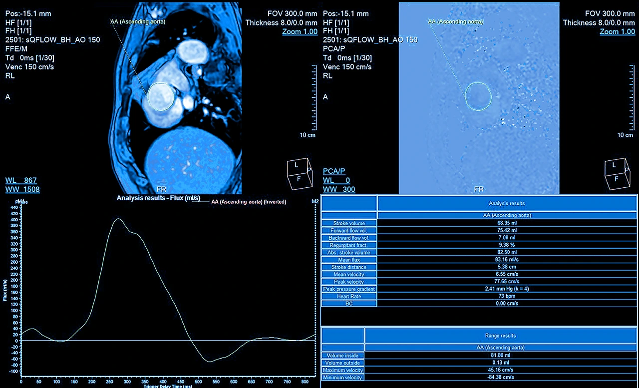 Monitor que presenta resultados en tiempo real de una prueba de esfuerzo que está realizando un paciente. Monitor que presenta resultados en tiempo real de una prueba de esfuerzo que está realizando un paciente.