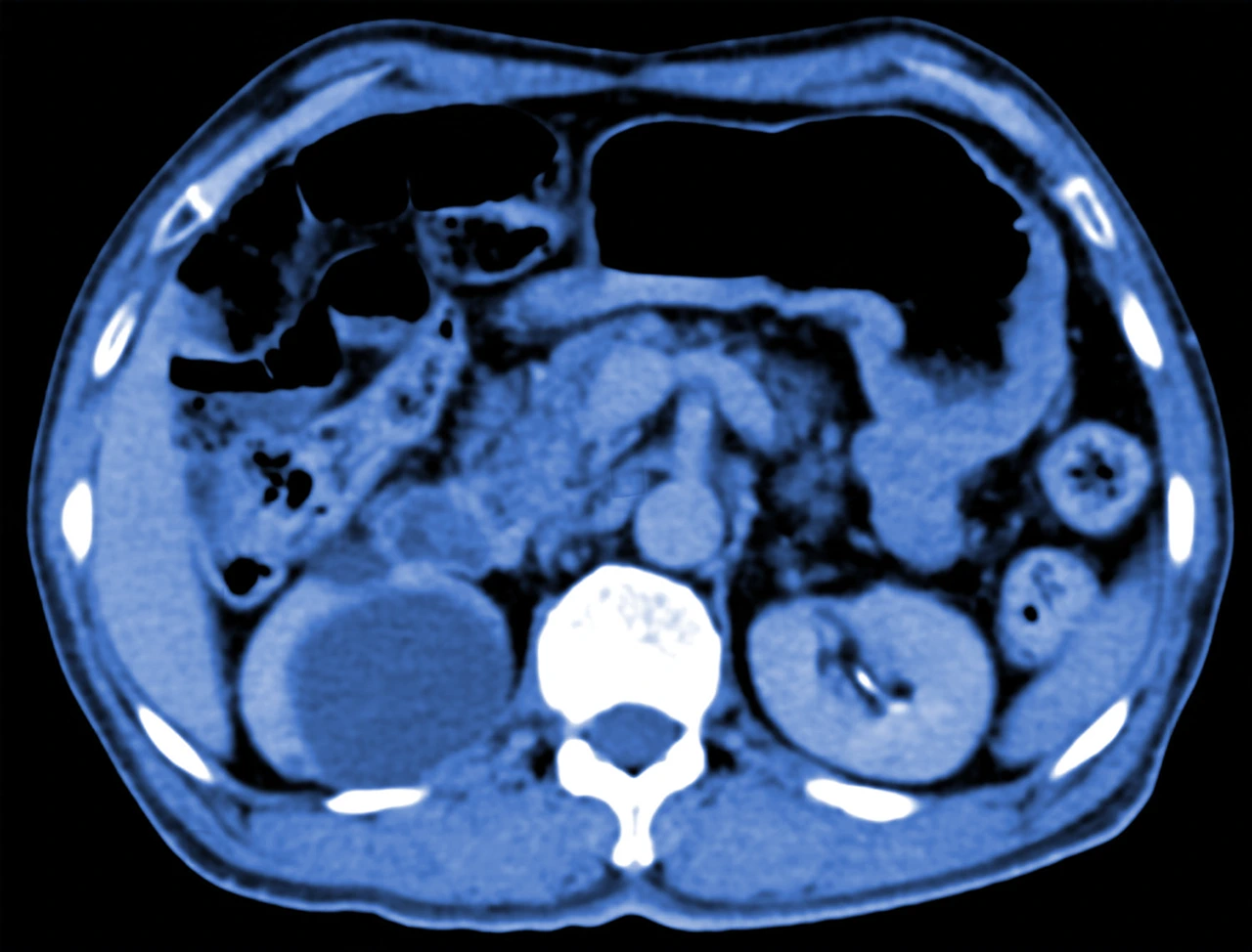 Tomografía computarizada de quiste renal, como método diagnóstico para la identificación de esta condición. Tomografía computarizada de quiste renal, como método diagnóstico para la identificación de esta condición.