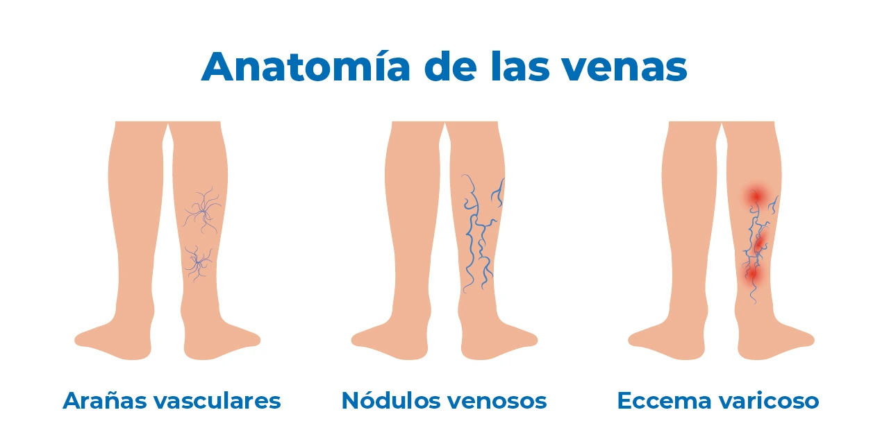 Dibujo de condiciones que aborda un angiólogo sobre la anatomía venosa de las venas varicosas. Arañas vasculares, nódulos venosos y eccema varicoso.