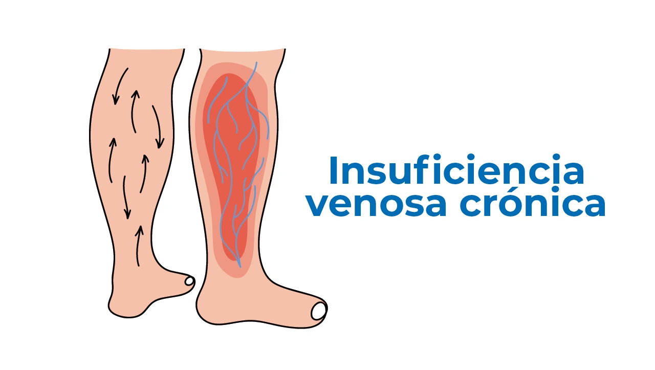 Ilustración sobre la condición que trata el angiólogo de insuficiencia venosa crónica. Ilustración sobre la condición que trata el angiólogo de insuficiencia venosa crónica.