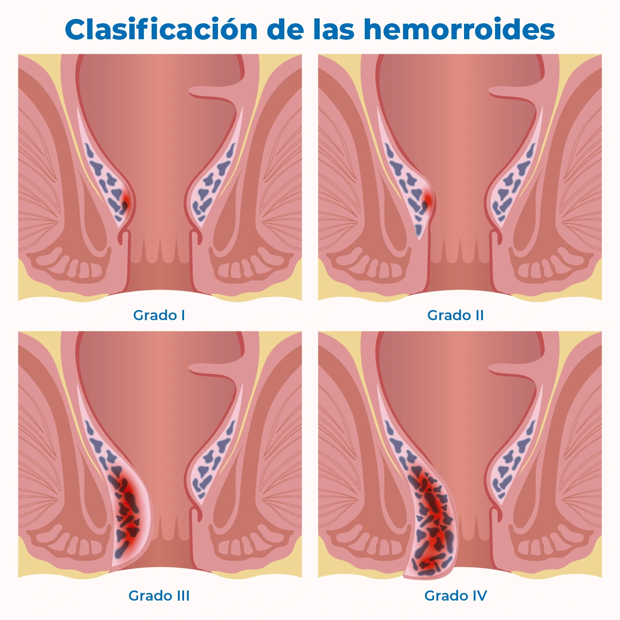 Ilustración que representa la clasificación de las hemorroides, acción relevante al momento de elegir cómo curar las hemorroides. Ilustración que representa la clasificación de las hemorroides, acción relevante al momento de elegir cómo curar las hemorroides.