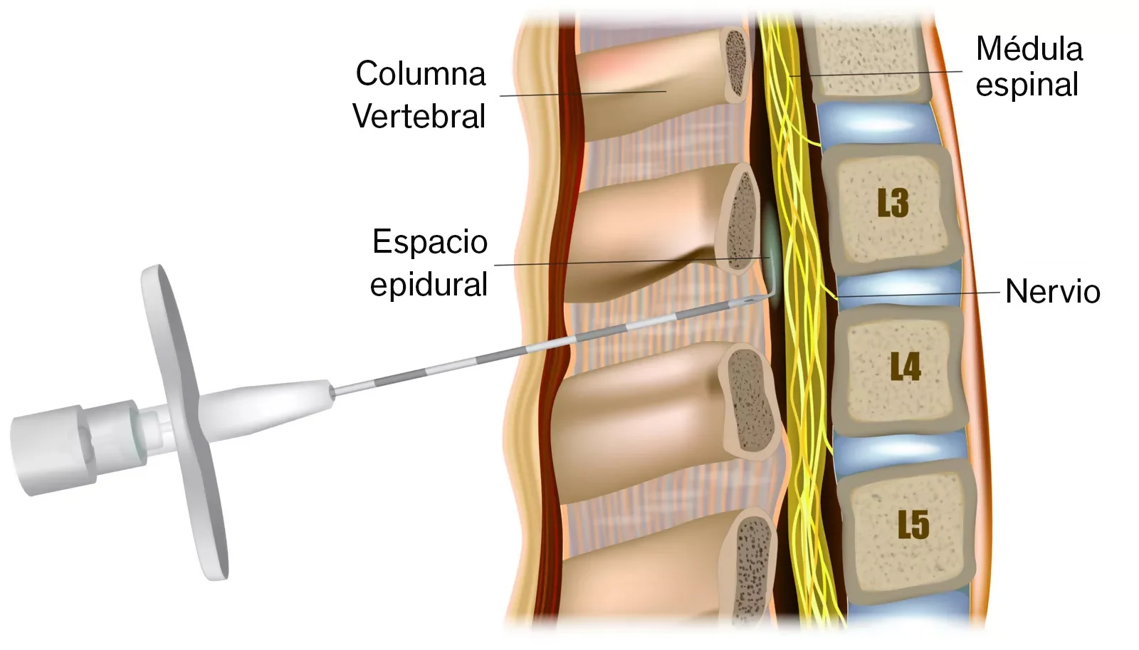 Ilustración que ejemplifica como la inyección epidural es colocada, permitiendo administrar el medicamento en la zona indicada.