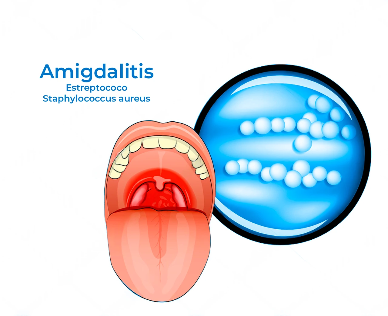 Ilustración de cómo la faringitis aguda puede presentar inflamación y formación de tonsilolitos en la garganta. Ilustración de cómo la faringitis aguda puede presentar inflamación y formación de tonsilolitos en la garganta.