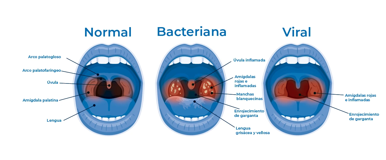 Ilustración sobre cómo se puede ver afectada la boca con una faringitis aguda, dependiendo de su origen viral o bacteriana. Ilustración sobre cómo se puede ver afectada la boca con una faringitis aguda, dependiendo de su origen viral o bacteriana.