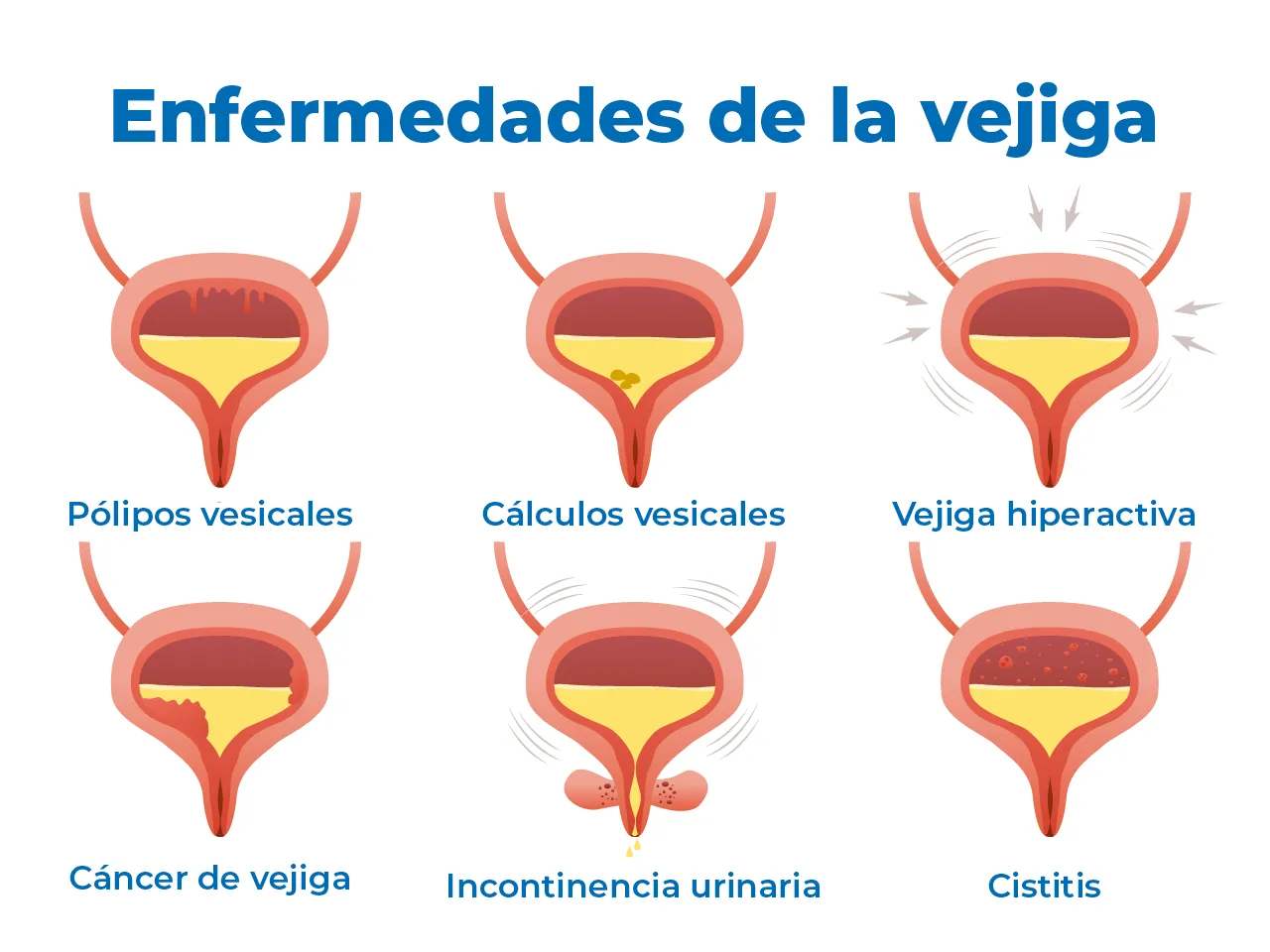 Ilustración de las enfermedades que el urólogo puede abordar en la vejiga, con seis ejemplos. Ilustración de las enfermedades que el urólogo puede abordar en la vejiga, con seis ejemplos.