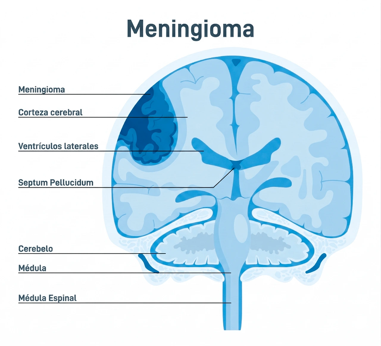 Ilustración de un meningioma, en el cáncer cerebral es el tipo de tumor primario que con mayor frecuencia se presenta. Ilustración de un meningioma, en el cáncer cerebral es el tipo de tumor primario que con mayor frecuencia se presenta.