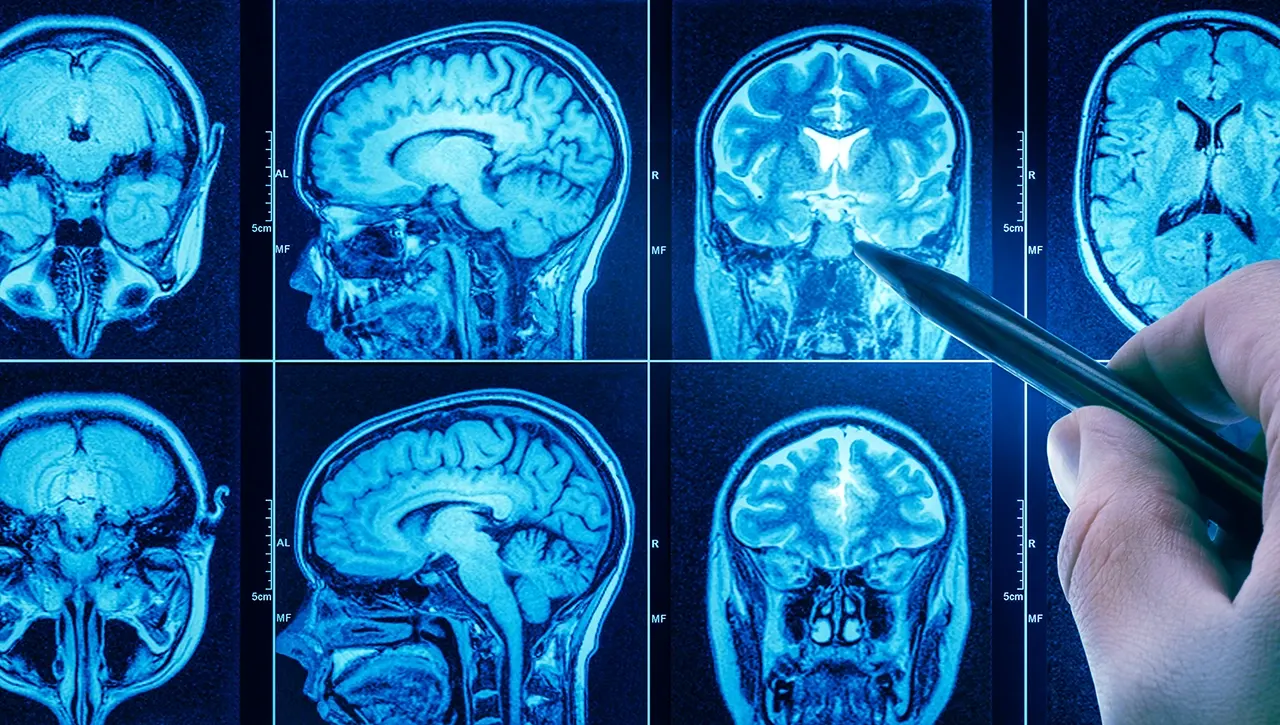 Tomografía realizada debido a la sospecha de cáncer cerebral, como parte de los estudios diagnósticos por imagen.