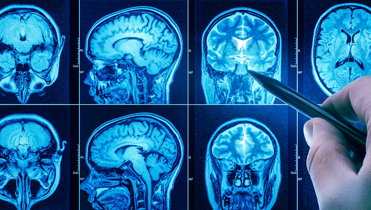 Tomografía realizada debido a la sospecha de cáncer cerebral, como parte de los estudios diagnósticos por imagen. Tomografía realizada debido a la sospecha de cáncer cerebral, como parte de los estudios diagnósticos por imagen.