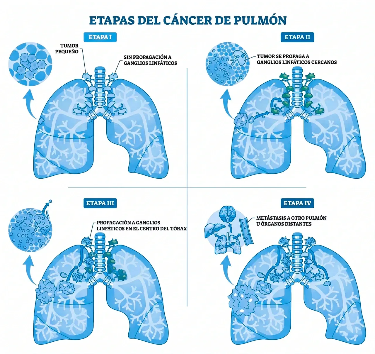 Ilustración que aborda en el cáncer de pulmón síntomas diversos, en función a las etapas de esta enfermedad. Ilustración que aborda en el cáncer de pulmón síntomas diversos, en función a las etapas de esta enfermedad.