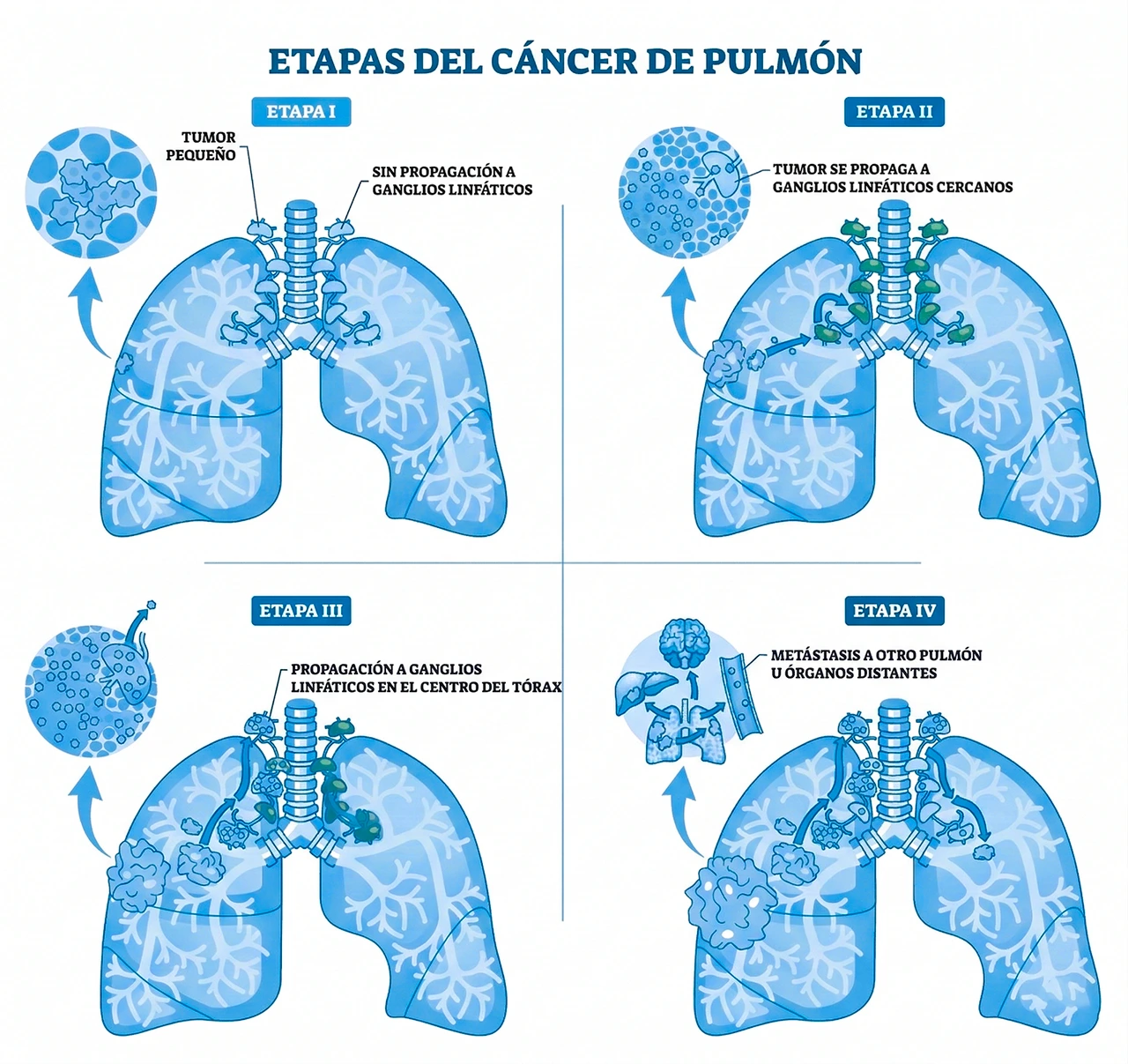 Ilustración que aborda en el cáncer de pulmón síntomas diversos, en función a las etapas de esta enfermedad. Ilustración que aborda en el cáncer de pulmón síntomas diversos, en función a las etapas de esta enfermedad.