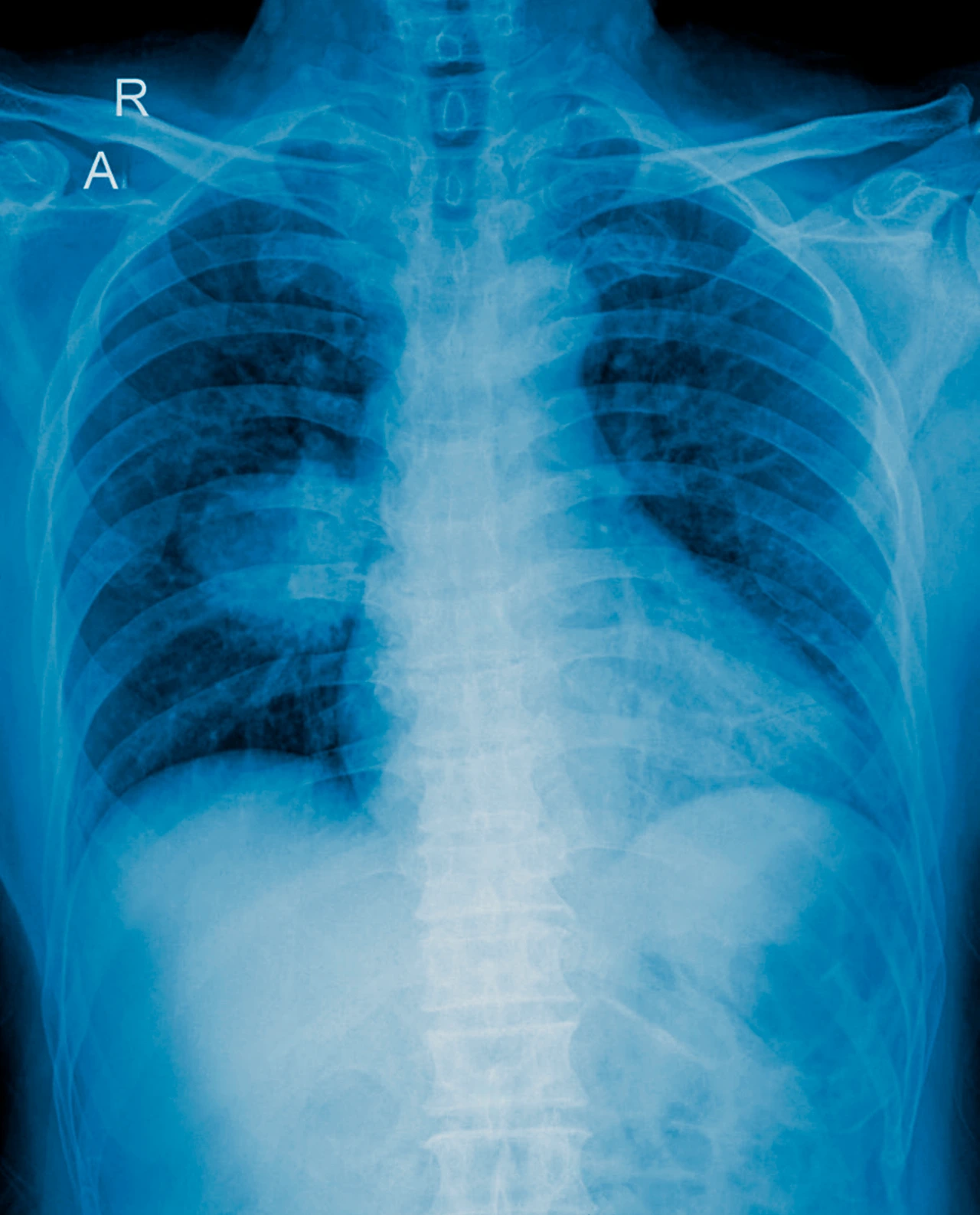 Radiografía de tórax mostrando una masa tumoral relacionada con cáncer de pulmón síntomas y diagnóstico médico. Radiografía de tórax mostrando una masa tumoral relacionada con cáncer de pulmón síntomas y diagnóstico médico.