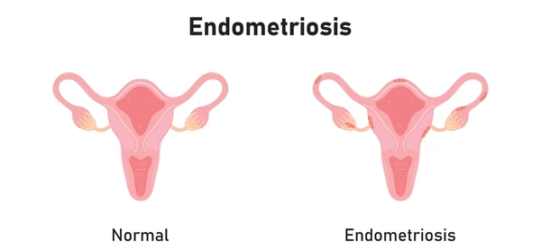 Ilustración que ayuda a entender cómo saber si tengo endometriosis al mostrar cómo se ve un aparato reproductor femenino normal o con esta condición.