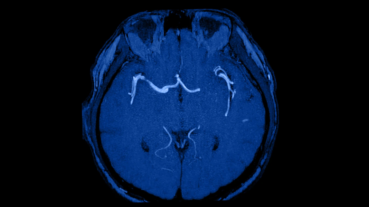 Estudio de imagen que se emplea para diagnosticar la enfermedad cerebrovascular al permitir ver el sistema vascular.
