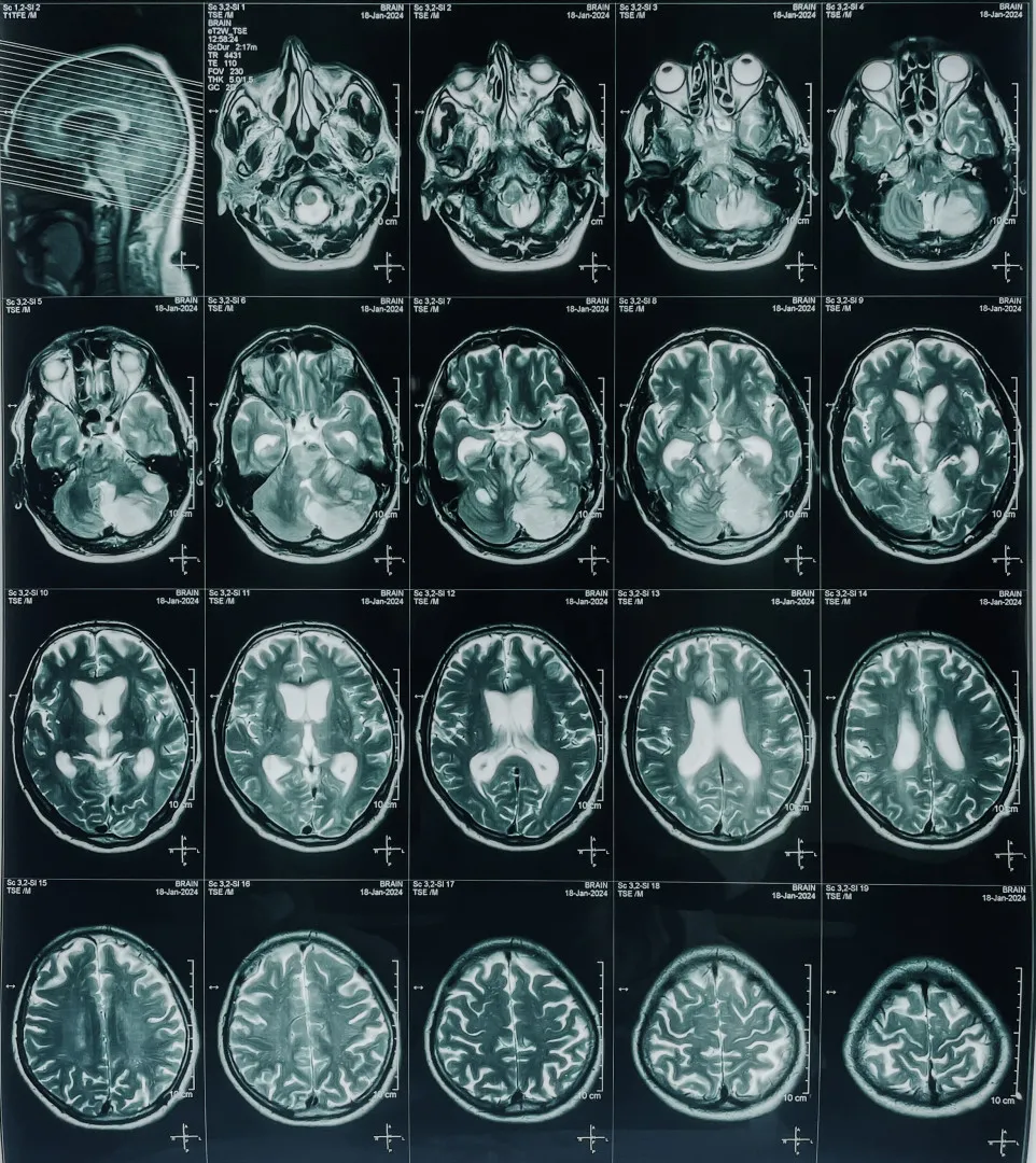 Resonancia magnética realizada para identificar la presencia de un EVC en un paciente. Resonancia magnética realizada para identificar la presencia de un EVC en un paciente.
