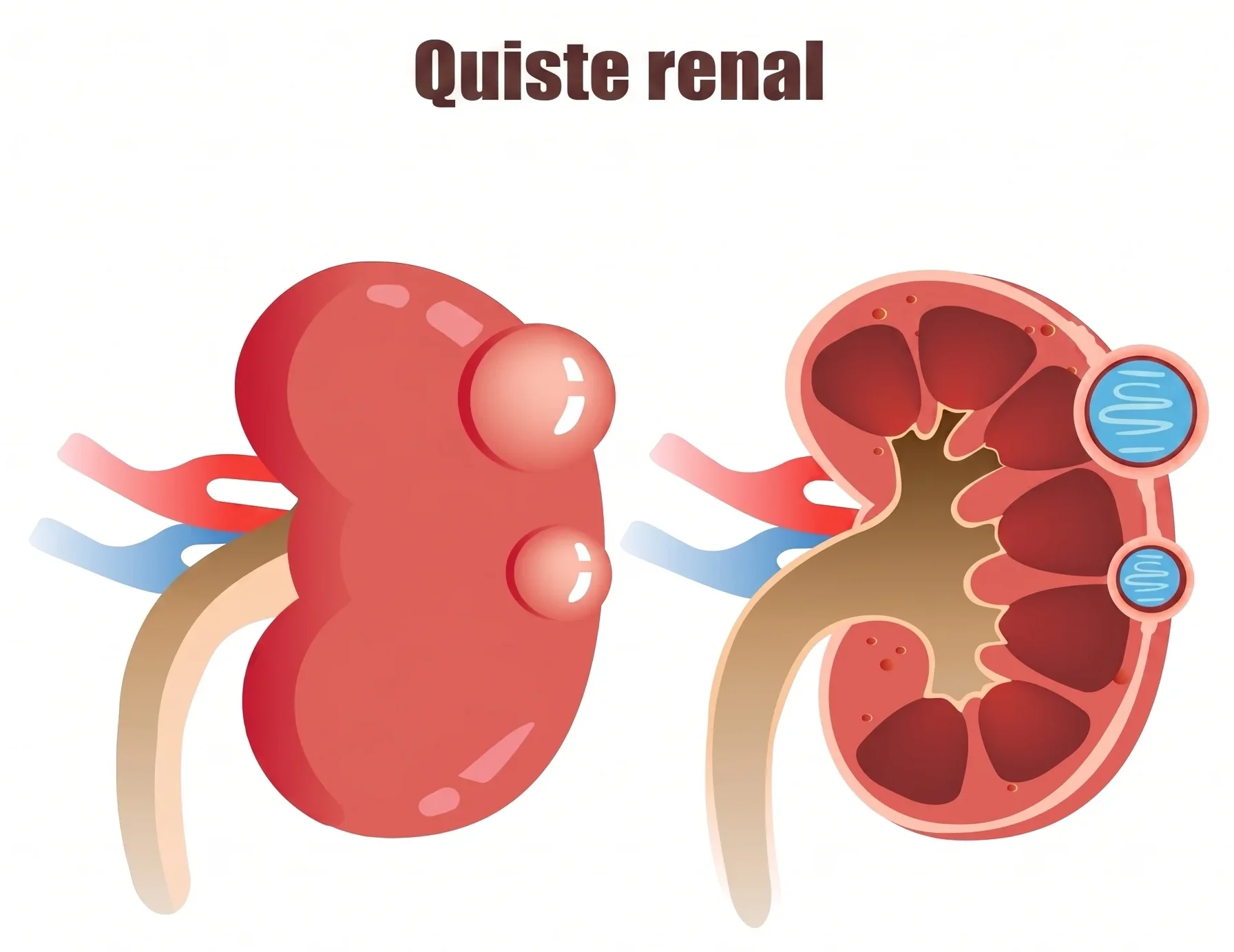 Ilustración de lo que es un quiste renal y cómo se podría llegar a presentar en una persona. Ilustración de lo que es un quiste renal y cómo se podría llegar a presentar en una persona.