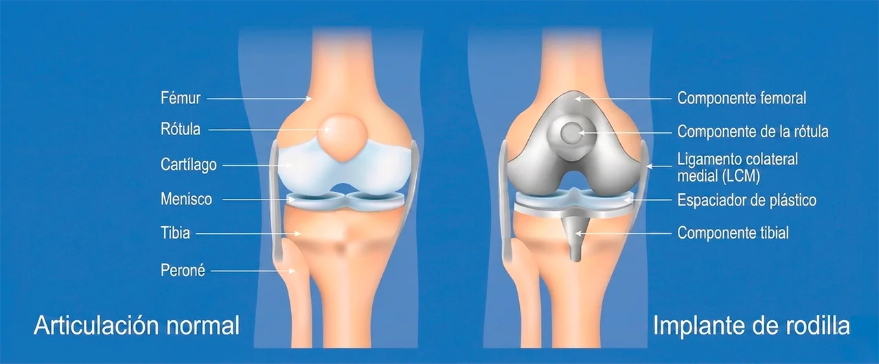 Ilustración para ejemplificar la artroplastia de rodilla, mostrando cómo se ve una rodilla normal y otra tras el reemplazo articular.