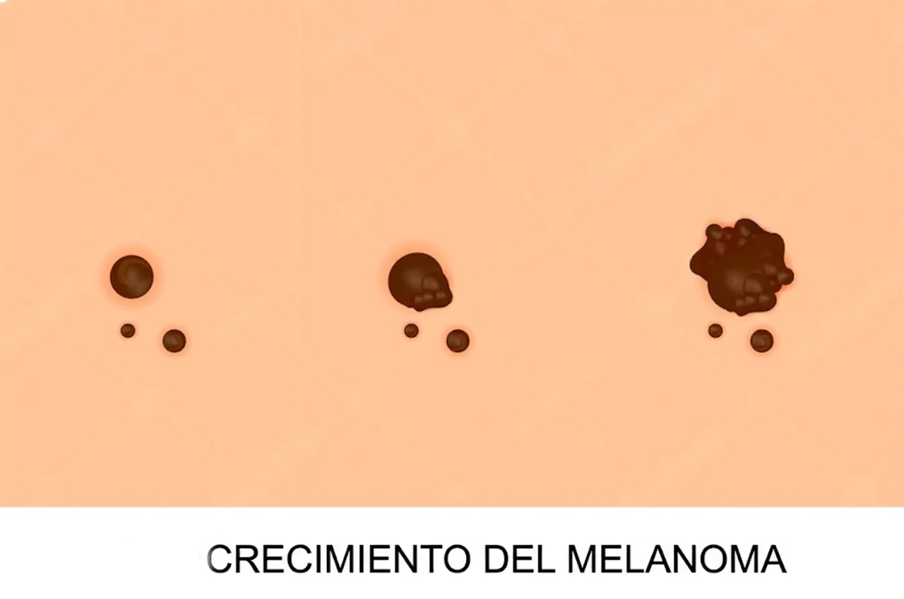 Ilustración que ejemplifica como el melanoma inicial puede ir creciendo en la piel de una persona. Ilustración que ejemplifica como el melanoma inicial puede ir creciendo en la piel de una persona.
