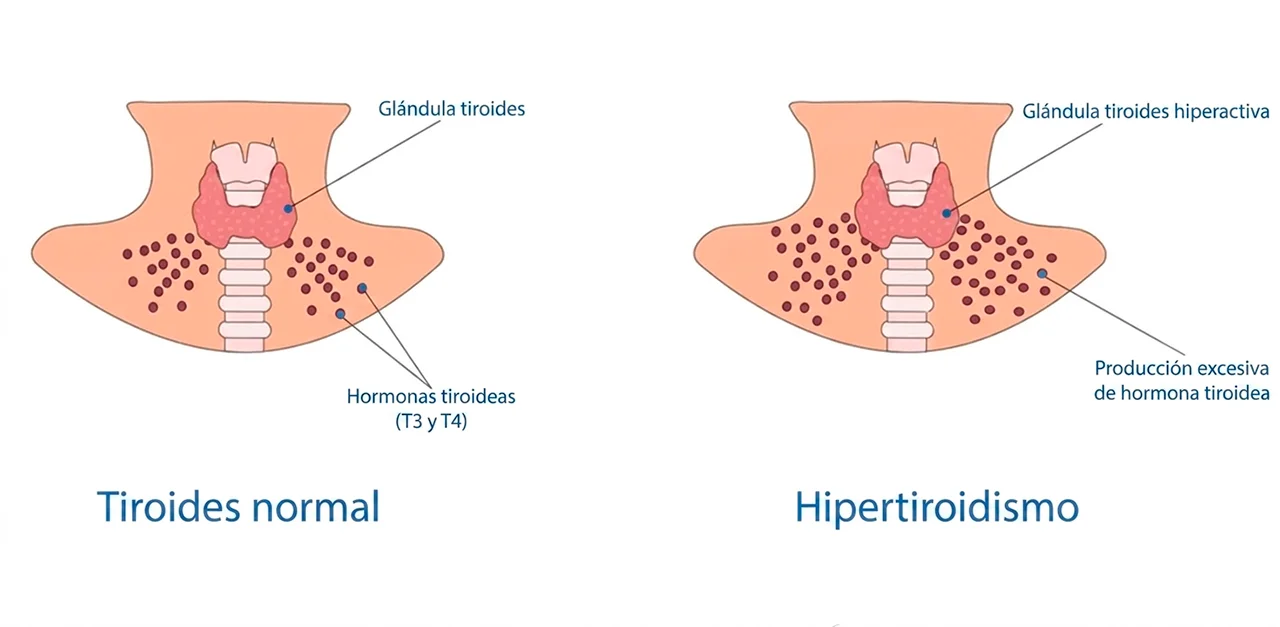 Ilustración que aborda la causa de los síntomas de tiroides que se pueden presentar en el hipertiroidismo.