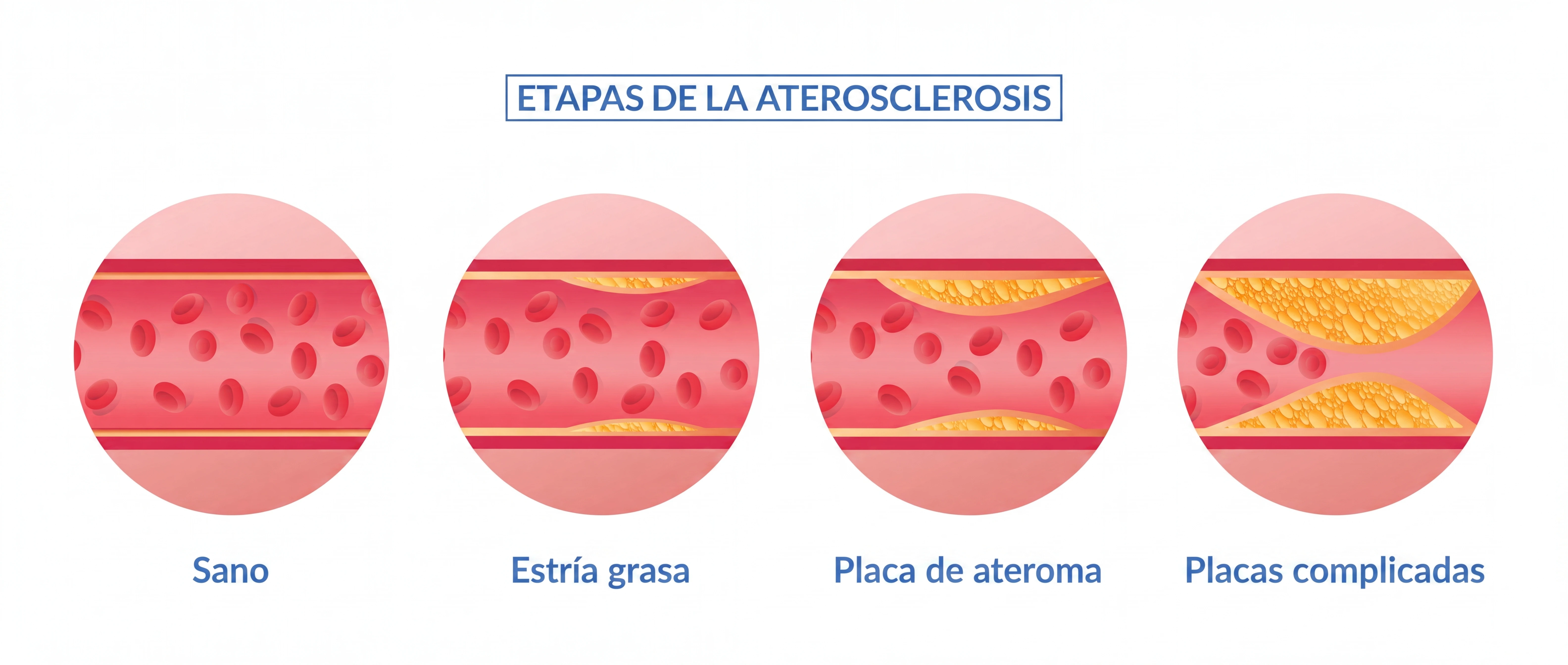 Ilustración que presenta los diferentes niveles de ateroesclerosis en las arterias.