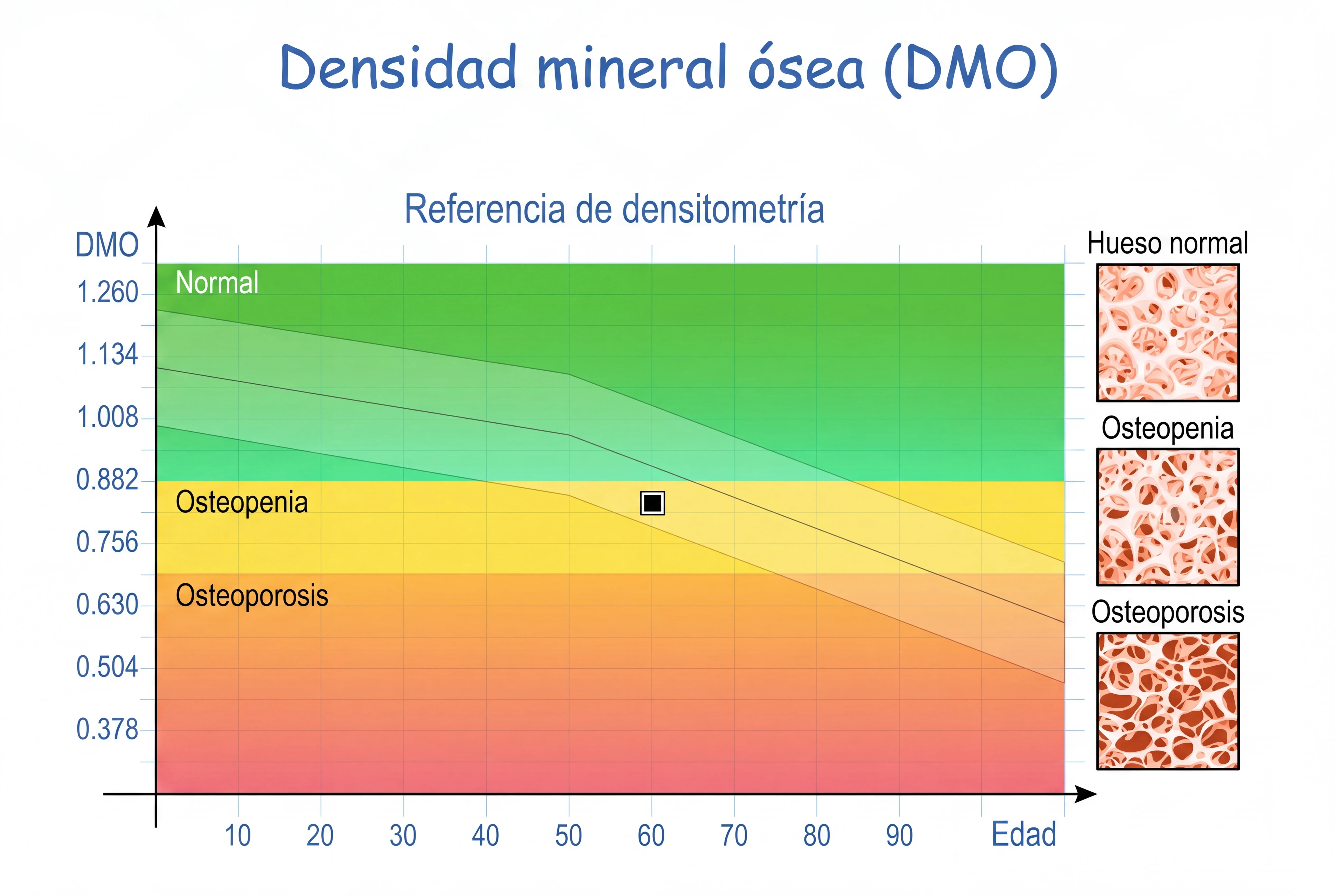 Resultados de una densitometría que permite conocer los niveles de densidad ósea.