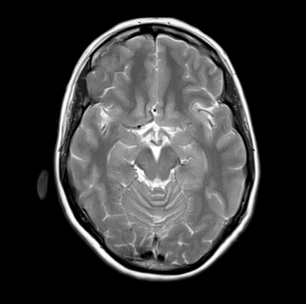 Resonancia magnética realizada en la neurofisiología para identificar la patología del paciente.