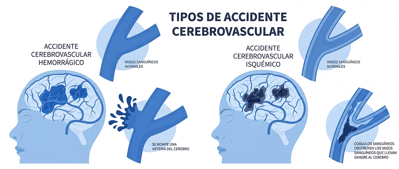 Ilustración en donde se muestran los tipos de derrame cerebral, que pueden originar los síntomas. Ilustración en donde se muestran los tipos de derrame cerebral, que pueden originar los síntomas.