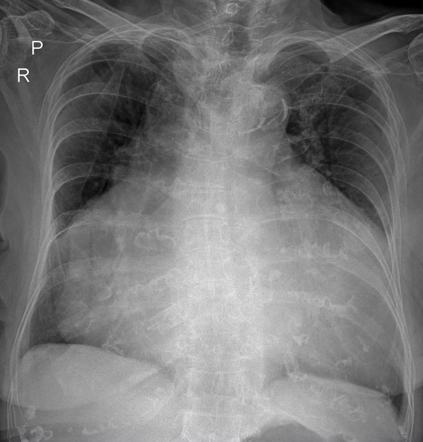 Radiografía del tórax de un paciente que ha desarrollado tanto derrame pericárdico como cardiomegalia. Radiografía del tórax de un paciente que ha desarrollado tanto derrame pericárdico como cardiomegalia.