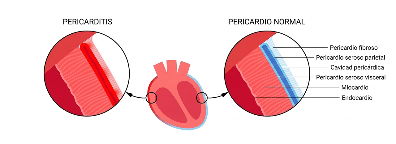 Ilustración de un pericardio normal y de la pericarditis, donde se indica la pericardiocentesis.