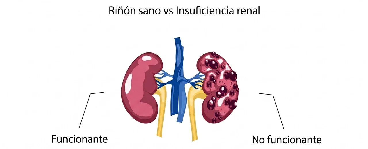 Ilustración de un riñón sano y otro con falla, que requiere tratamiento de la insuficiencia renal.