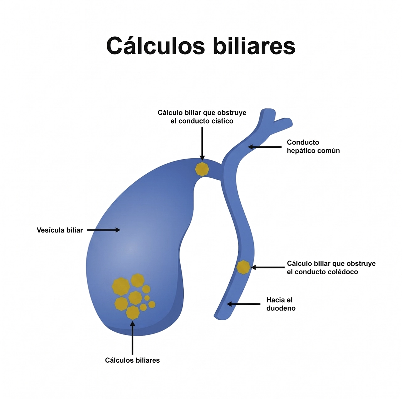 Ilustración de cómo se ven los cálculos biliares y cómo se mueven.