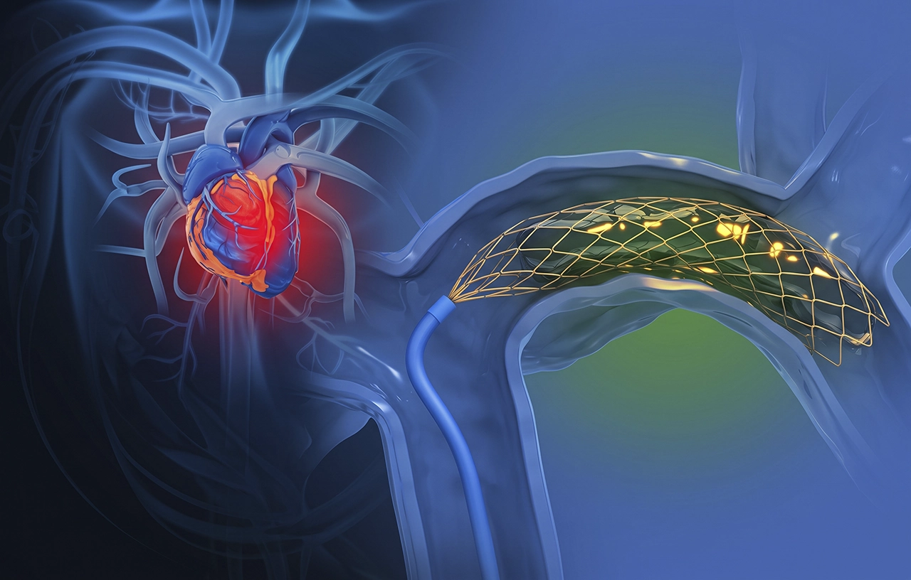 Ilustración de un cateterismo cardíaco, para la realización de una angioplastia con stent.