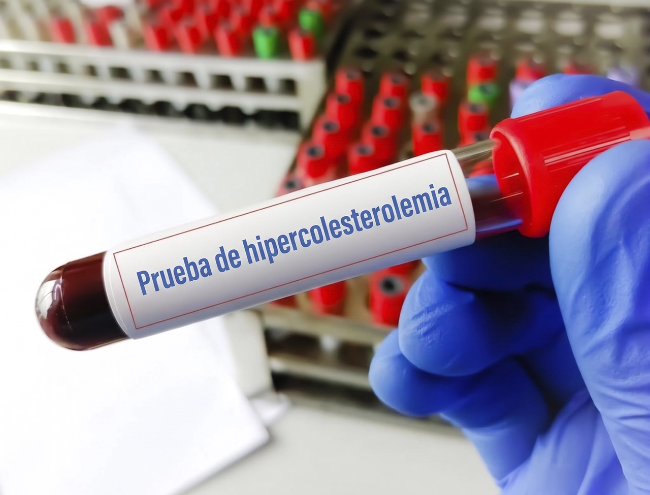 Frasco con muestra de sangre para realizar, como parte del diagnóstico de dislipidemia la prueba de hipercolesterolemia.