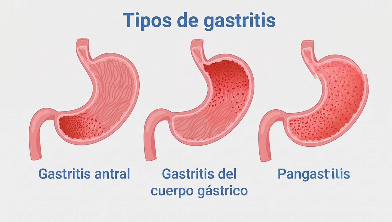 Dibujo que representa, dentro de las enfermedades digestivas, la gastritis en sus diferentes tipos.