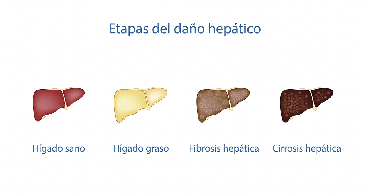 Ilustración que ejemplifica en la esteatosis hepática los diferentes grados de daño en el hígado. Ilustración que ejemplifica en la esteatosis hepática los diferentes grados de daño en el hígado.