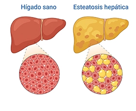 Ilustración de un hígado sano y otro hígado con esteatosis hepática. Ilustración de un hígado sano y otro hígado con esteatosis hepática.