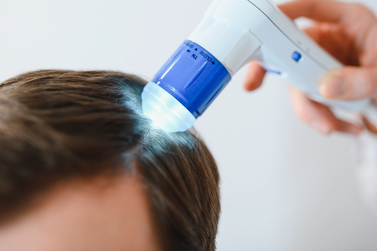 Especialista evaluando el cuero cabelludo de un hombre debido a la presencia de foliculitis, mediante el uso de un tricoscopio.