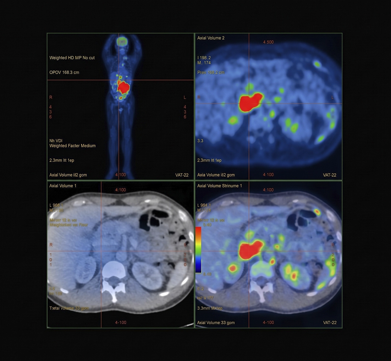 Resultados en un monitor del estudio PET/CT realizado a un paciente. Resultados en un monitor del estudio PET/CT realizado a un paciente.