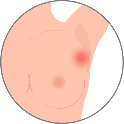 sintomas cancer Dolor en la axila sintomas cancer Dolor en la axila