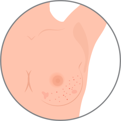 sintomas cancer irritación de la piel sintomas cancer irritación de la piel
