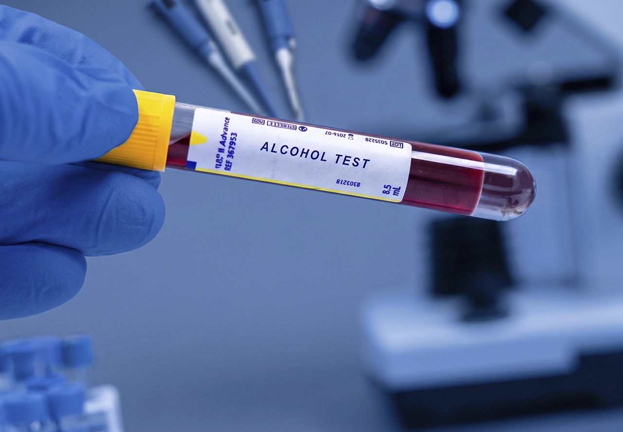 Muestra de sangre para identificar intoxicación por alcohol, en un paciente que presenta síntomas de intoxicación. Muestra de sangre para identificar intoxicación por alcohol, en un paciente que presenta síntomas de intoxicación.