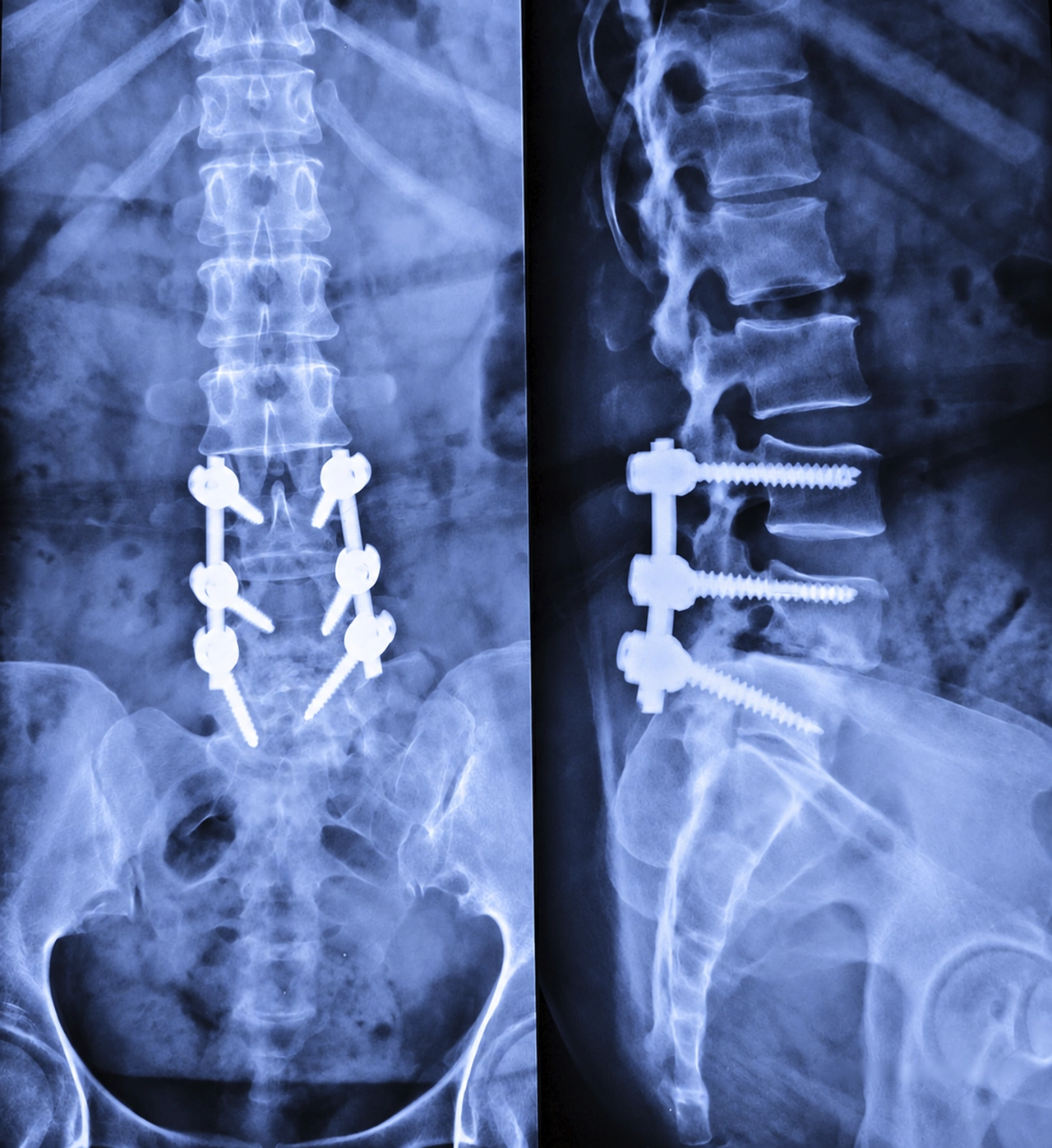 Radiografía mostrando fijación con tornillos pediculares en una cirugía de columna por fusión. Radiografía mostrando fijación con tornillos pediculares en una cirugía de columna por fusión.
