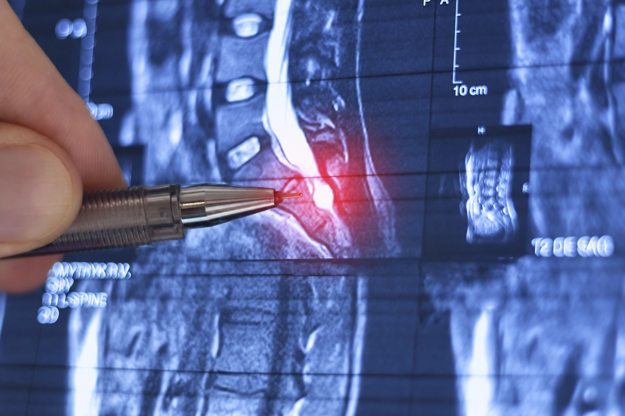Médico señalando una lesión en resonancia magnética para evaluar la necesidad de una cirugía de columna. Médico señalando una lesión en resonancia magnética para evaluar la necesidad de una cirugía de columna.